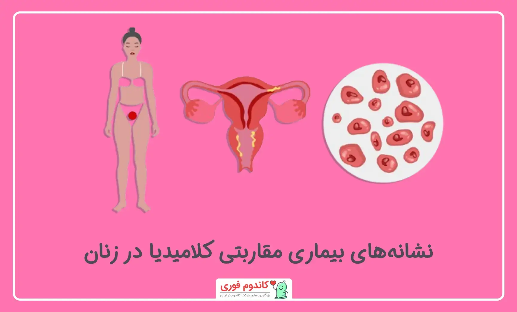 نشانه کلامیدیا در زنان