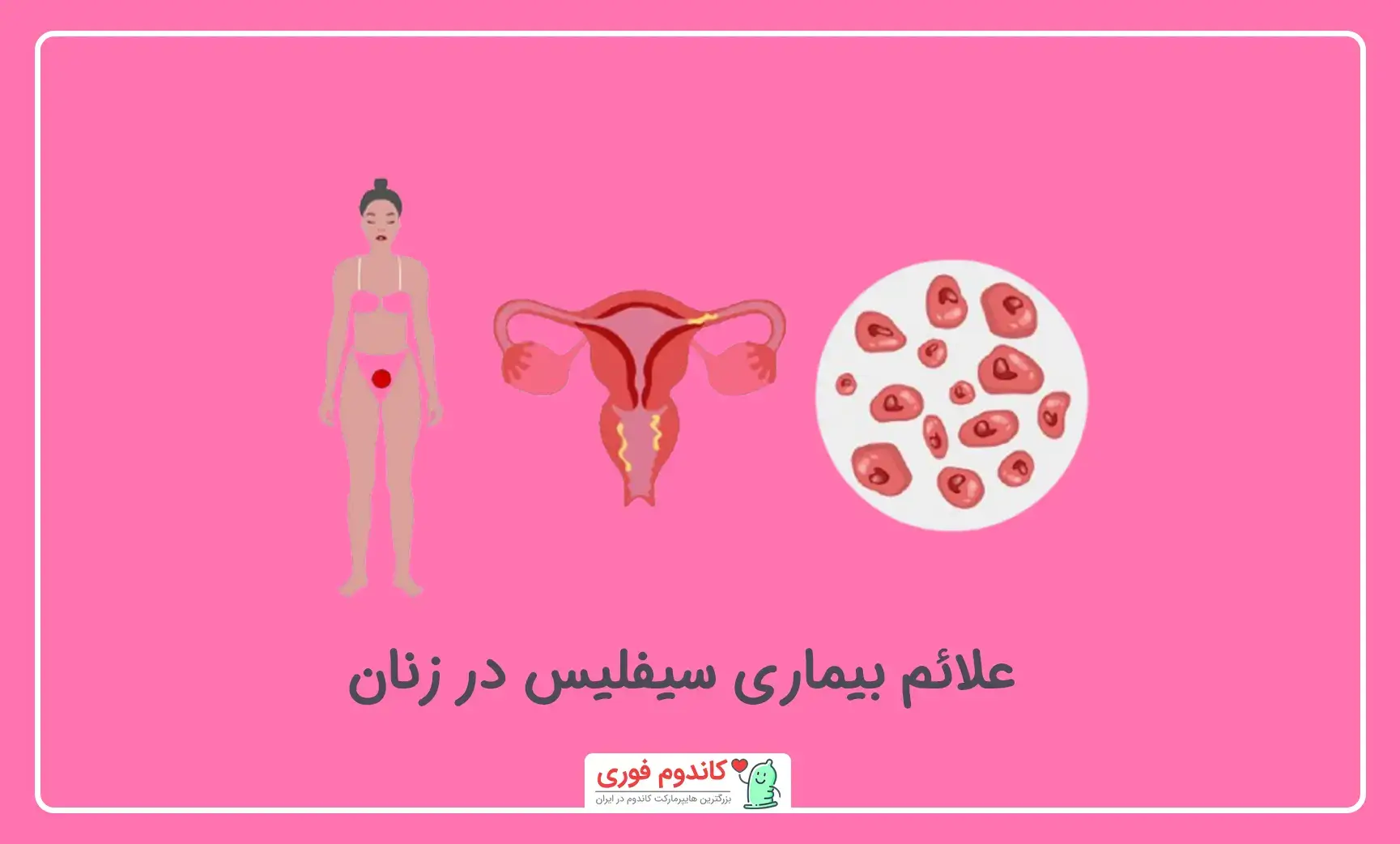 نشانه‌های سیفلیس در زنان